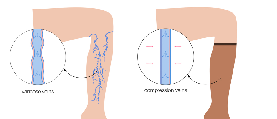 Κάλτσες διαβαθμισμένης συμπίεσης για φλεβική ανεπάρκεια - προβλήματα πίεσης με κιρσούς.