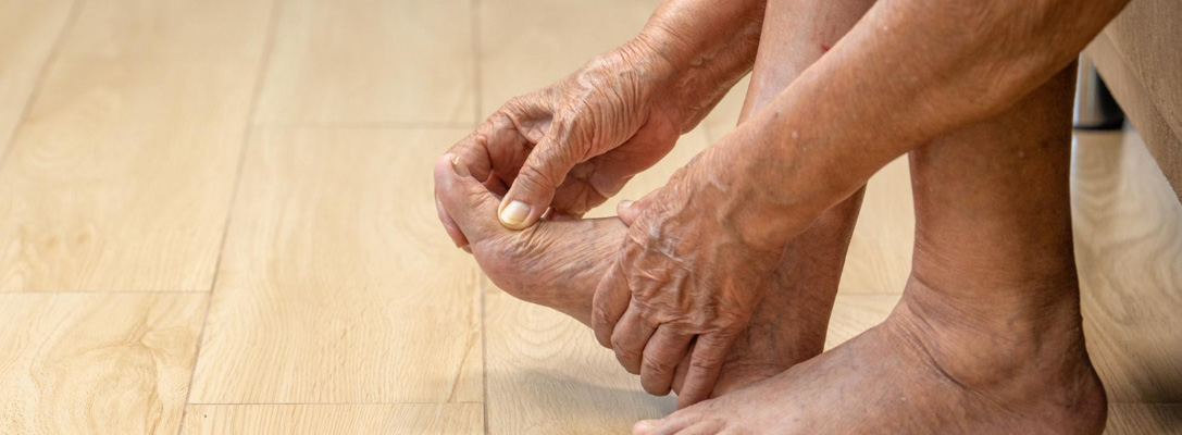 Θεματική εικόνα για διαβητικό πόδι, συμπτώματα και θεραπεία. Ηλικιωμένη γυναίκα τρίβει τα πρησμένα διαβητικά πόδια της.