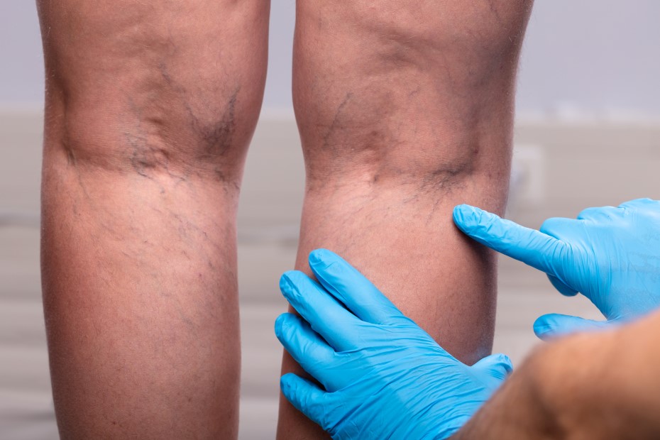 Θεματική εικόνα για το τι είναι η θρόμβωση. Πόδια με έντονες φλέβες εξετάζονται από γιατρό με μπλε γάντια.
